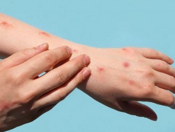 WHO: Kêu gọi châu Âu thực hiện hành động khẩn cấp bệnh đậu mùa khỉ