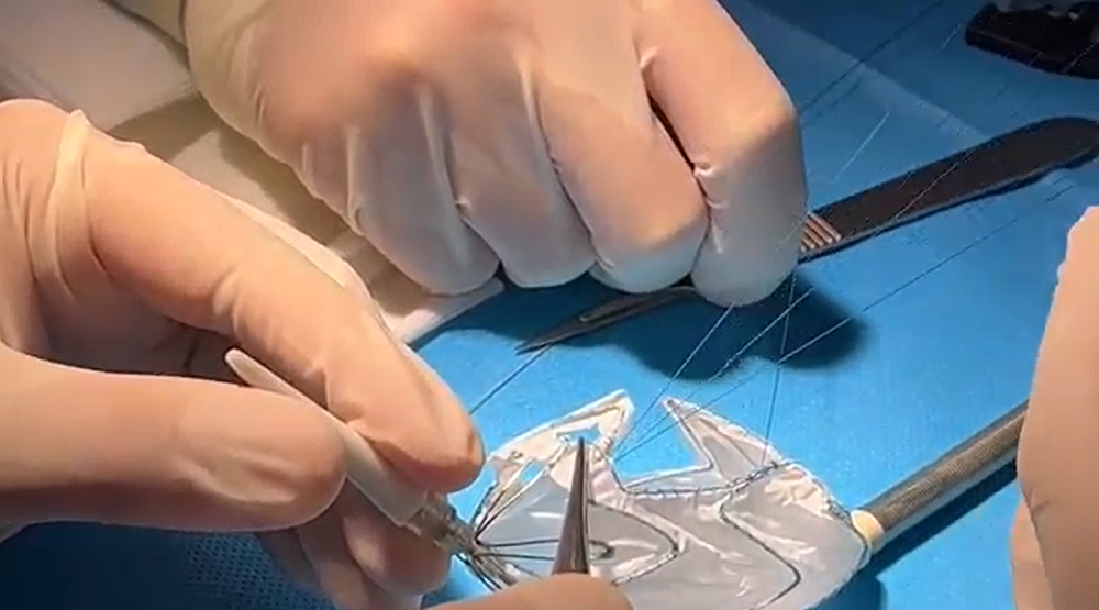 Mở cửa sổ trước khi đặt stent graft cho bệnh nhân.