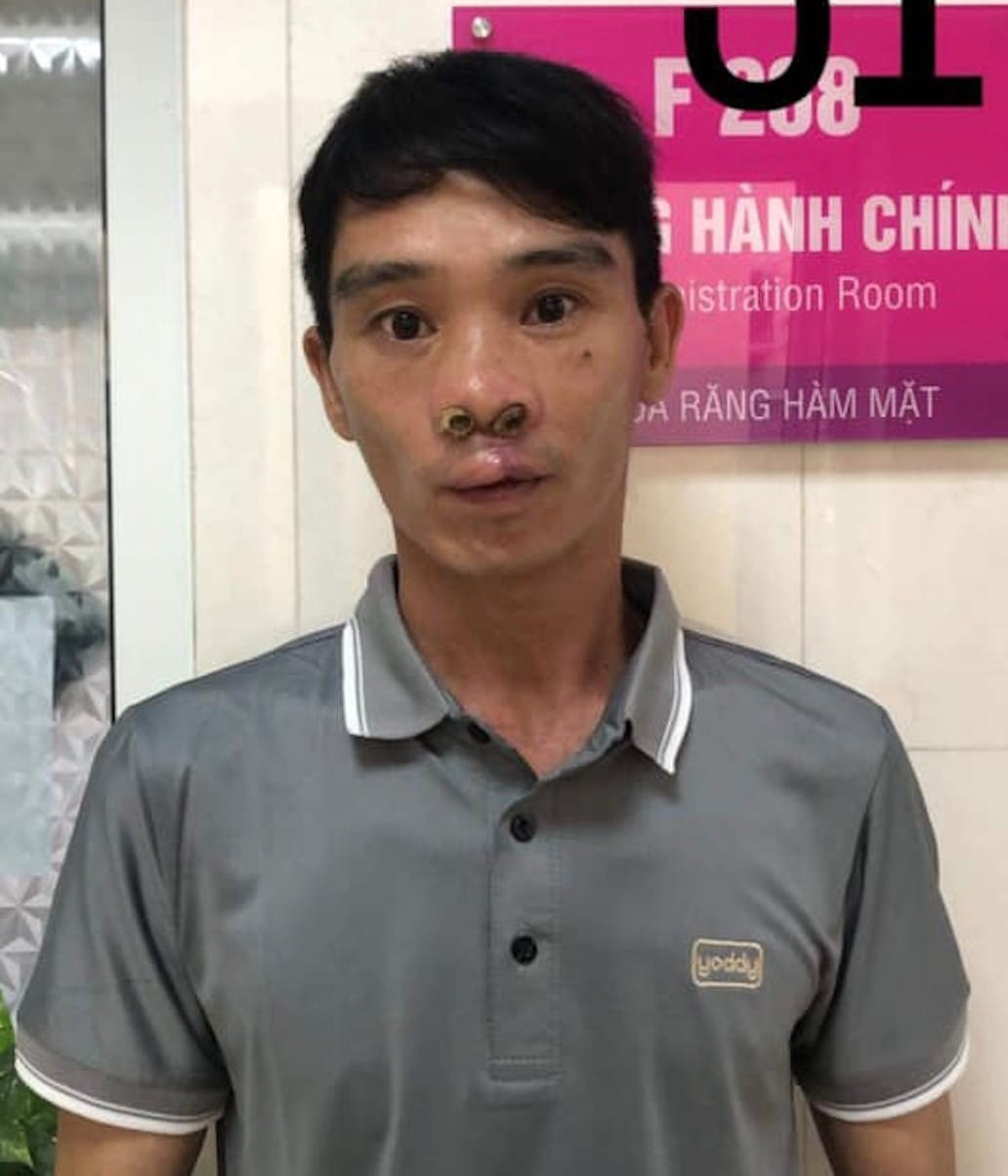 Anh Vi Văn Tản sau khi phẫu thuật thành công. (Ảnh: Operation Smile Việt Nam)