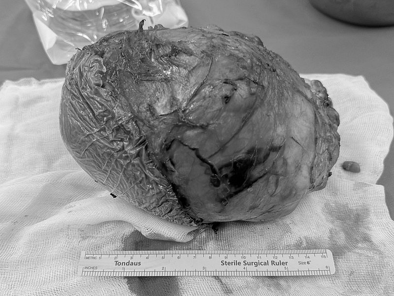 Bóc thành công khối u quái gần 2kg chèn ép vùng cổ cụ bà 81 tuổi Bóc thành công khối u quái gần 2kg chèn ép vùng cổ cụ bà 81 tuổi