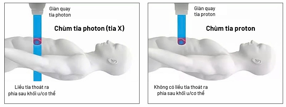 Xạ trị photon (tia X) đưa liều xạ vào khối u nhưng vẫn có thể “xuyên qua” phía sau, gây tổn thương mô lành quanh đường đi của tia; xạ trị proton hiện đại với tia năng lượng biết “dừng đúng chỗ” ngay vị trí khối u để tiêu diệt khối u hiệu quả và an toàn cao. Ảnh: Bệnh viện Đa khoa Tâm Anh