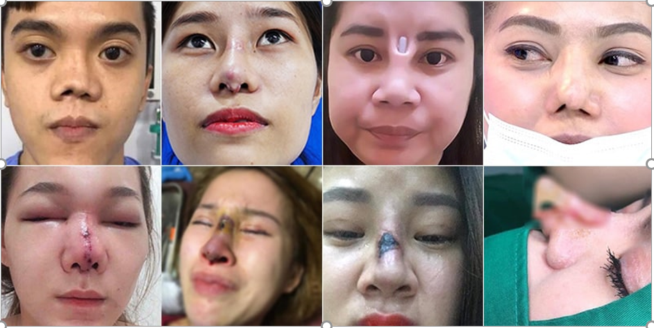 sau nang mui cat mi khach hang khong duoc ket qua nhu loi pr truoc do tham chi khach hang con gap phai tinh hu hong nang