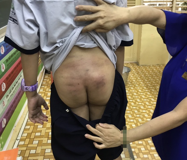 Làm rõ nghi vấn bé trai bị bạo hành khi ở cùng với bố đẻ và mẹ kế tại TP.HCM