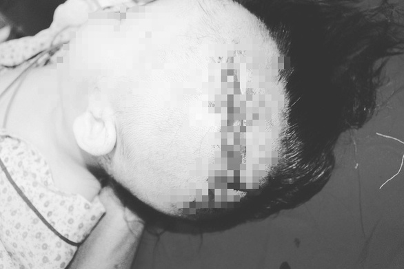 ha noi be gai 2 tuoi bi cho nuoi can rach mat lo xuong so