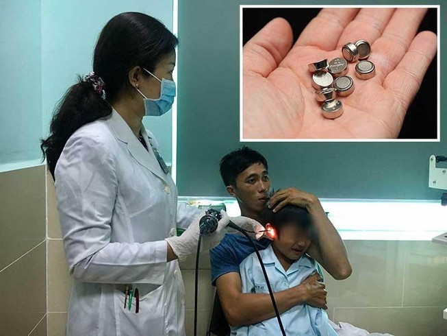 nhet pin dien tu vao tai be trai 5 tuoi bi thung mang nhi