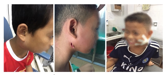 phat hien 3 tre nhiem vi khuan an thit nguoi o nghe an
