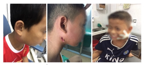 3 benh nhi mac benh whitmore o nghe an suc khoe chuyen bien tot 1 nguoi da duoc xuat vien