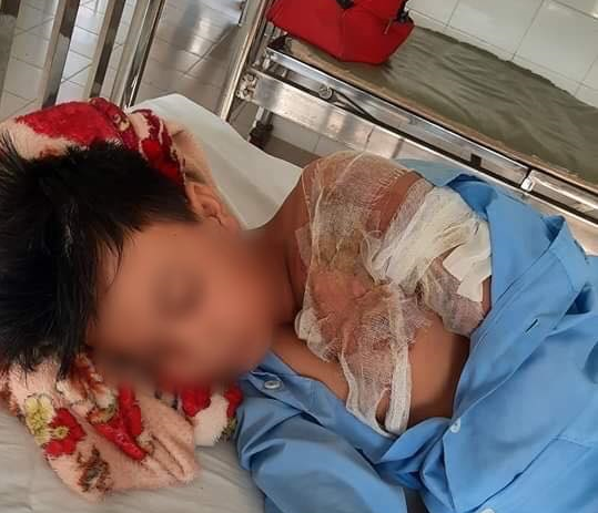 Vụ bé trai 8 tuổi nghi bị bố bạo hành, đổ nước sôi lên người ở Long An: Bỏng do pha cà phê?