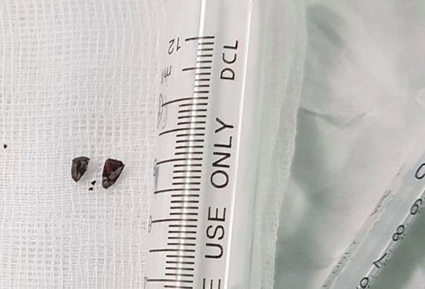 hue thanh nien bi manh phao tu che ban vao dau dem giao thua