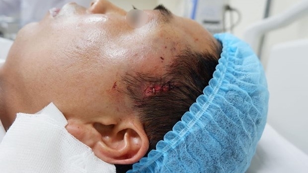 Hà Nội: Chảy máu ồ ạt vì độn thái dương ở thẩm mỹ viện không phép