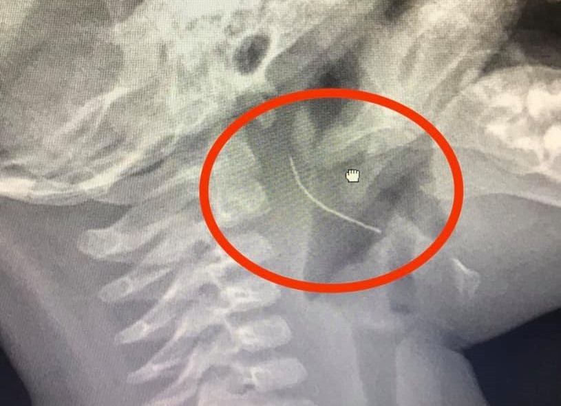 an chao luon ngoai hang be 13 thang tuoi bi hoc manh thep dai 2cm