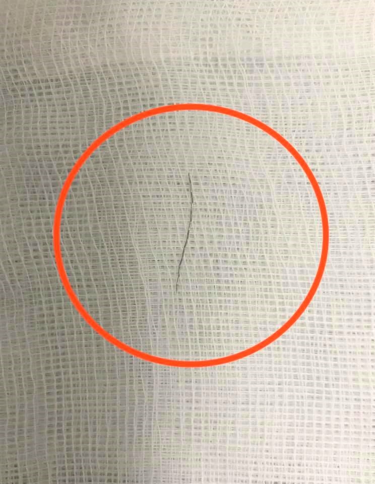 an chao luon ngoai hang be 13 thang tuoi bi hoc manh thep dai 2cm