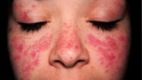 Bệnh lupus ban đỏ có nguy hiểm không? Triệu chứng bệnh như thế nào?