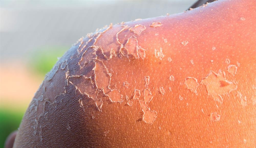 8 cach chua chay nang cho lan da sieu toc ngay tai nha