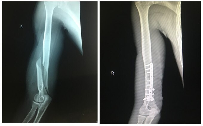 choi vat tay voi ban nam thanh nien bi gay xuong canh tay