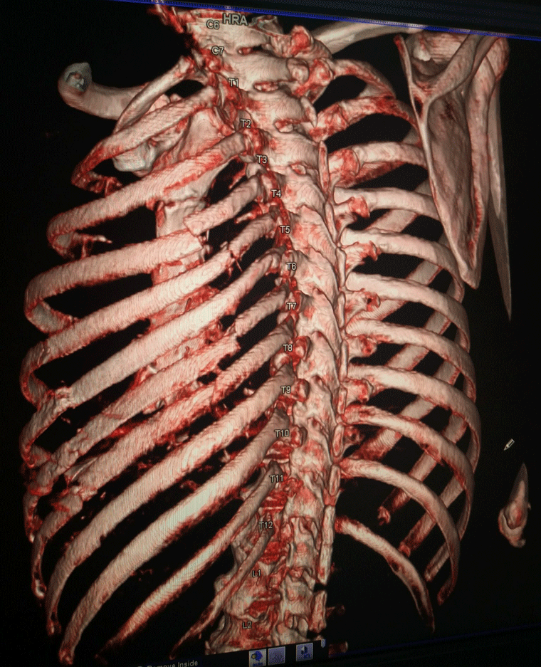 gay xuong suon chan thuong nguc nang vi va cham giao thong voi hon gach