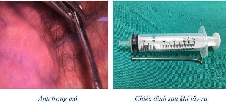 hy huu dinh dai 7cm lac troi tu vai xuong phoi thanh nien 18 tuoi