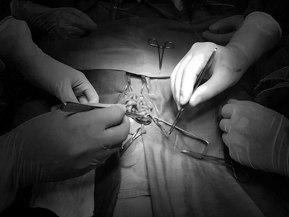 quang ninh be 2 ngay tuoi bi tac ruot bam sinh duoc mo kip thoi