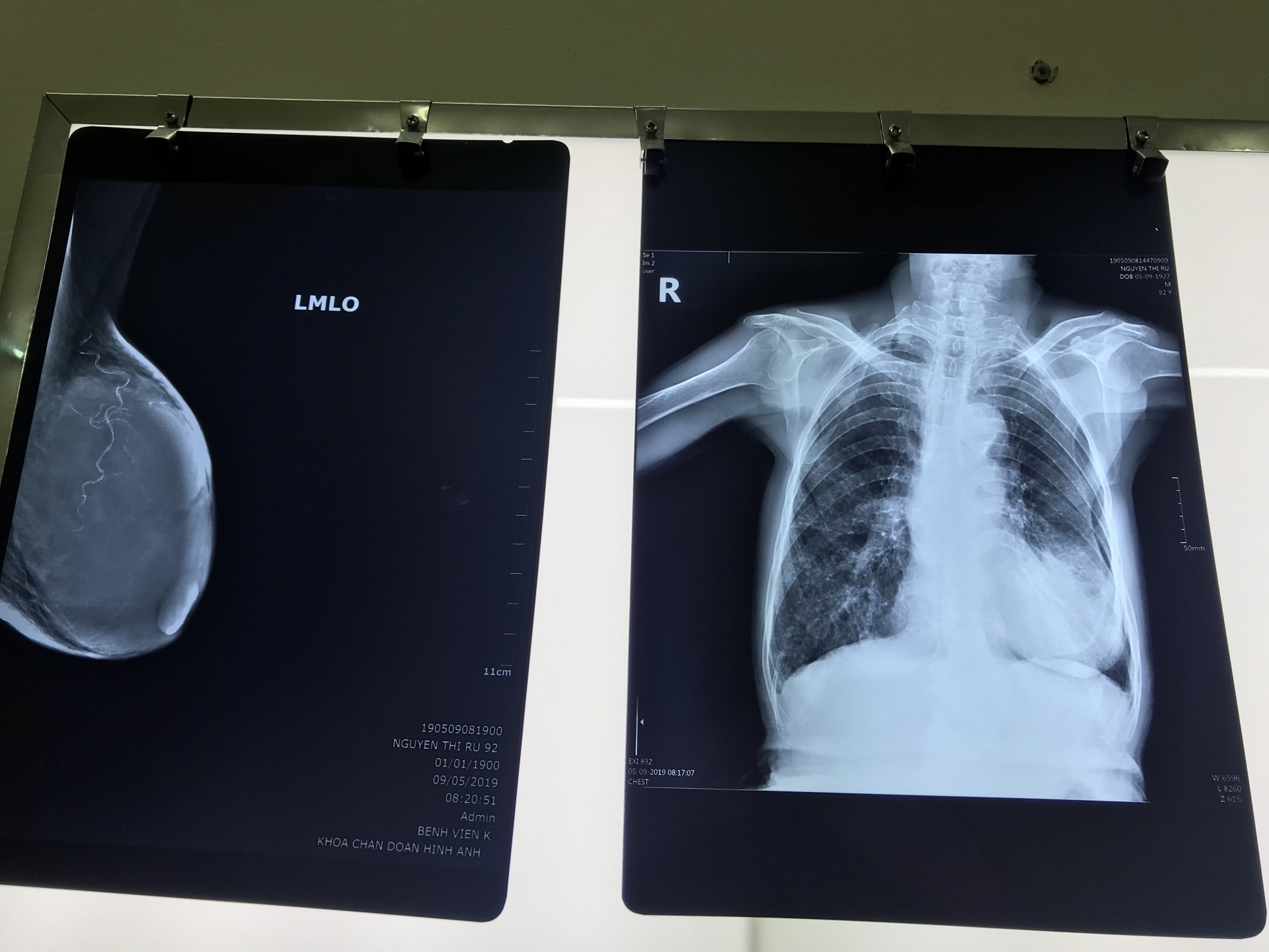 phau thuat thanh cong cho ba cu 92 tuoi mac ung thu vu