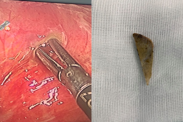 ha noi nu benh nhan thung ruot non do an bun suon qua nhanh