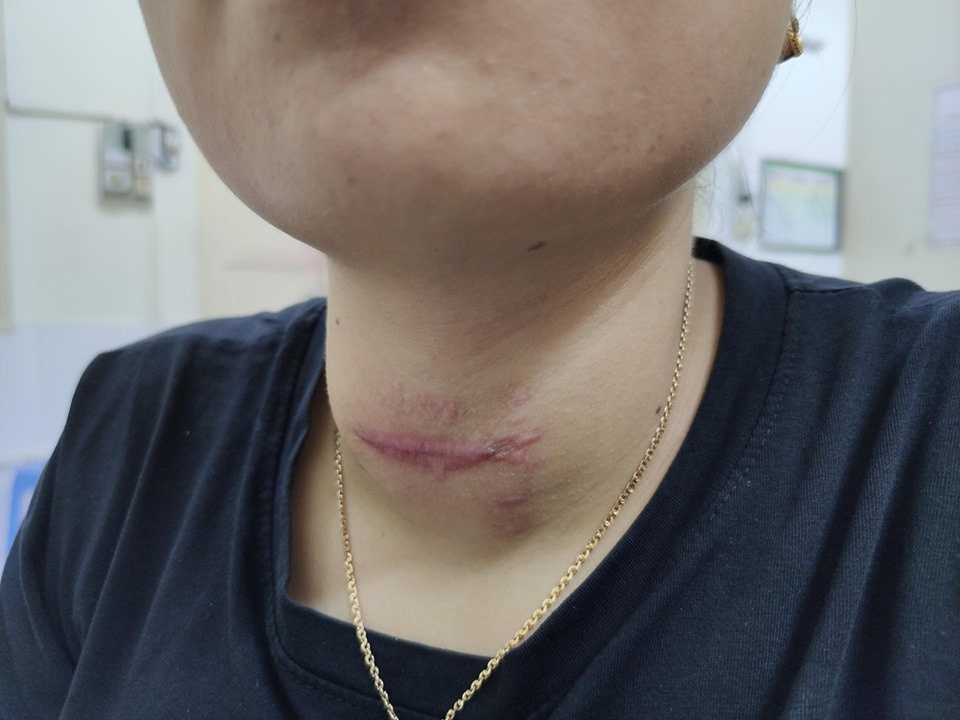 Tới thầy lang chữa Basedow, cô gái nhập viện gấp vì nhiễm trùng loét cổ nghiêm trọng toi thay lang chua basedow co gai nhap vien gap vi nhiem trung loet co nghiem trong