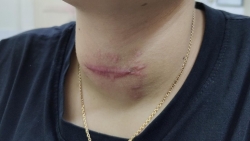 toi thay lang chua basedow co gai nhap vien gap vi nhiem trung loet co nghiem trong