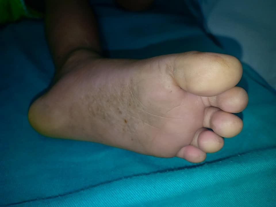 Bé gái 3 tuổi sốc phản vệ sau 5 phút bị kiến xoan đốt be gai 3 tuoi soc phan ve sau 5 phut bi kien xoan dot