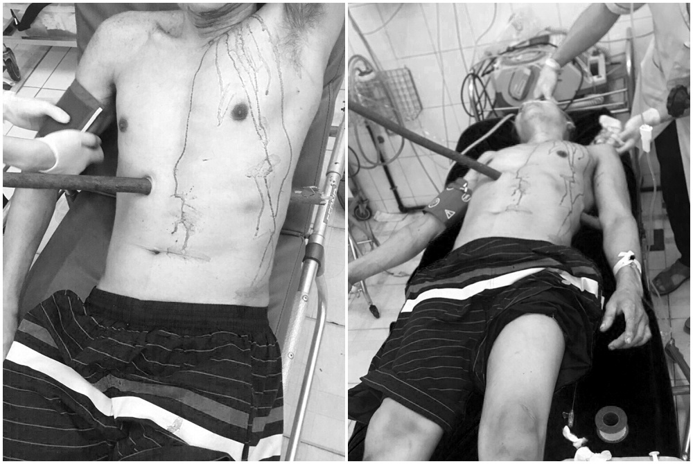 hy huu benh nhan bi coc dai 1m dam xuyen thau nguoi do truot nga tu cay