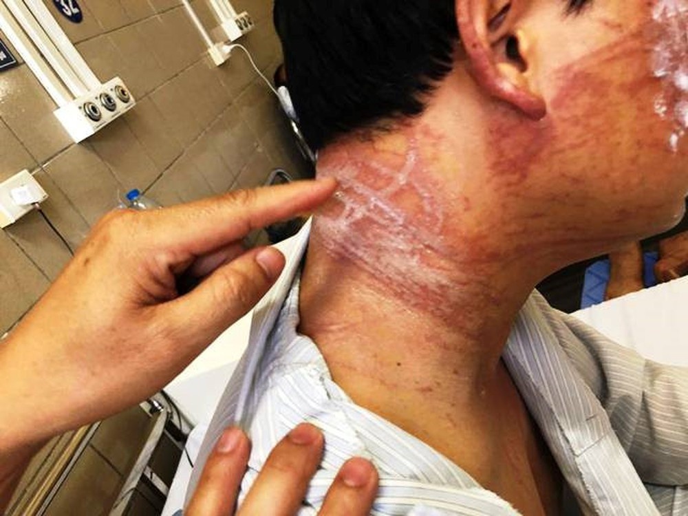 ha noi nam thanh nien bi hoai tu da vi bong sua lua