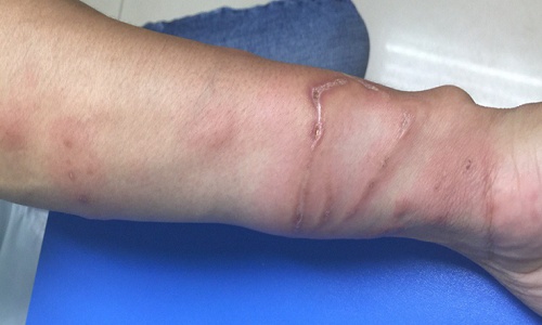 ha noi nam thanh nien bi hoai tu da vi bong sua lua