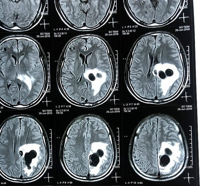 an tiet canh nguoi dan ong bi 5 o san lam to trong nao