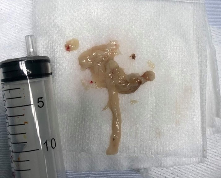 an tiet canh nguoi dan ong bi 5 o san lam to trong nao