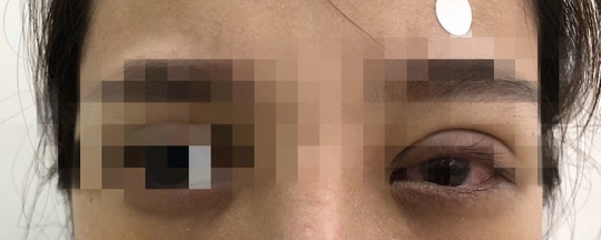 Nhấn mí làm đẹp ở spa, cô gái 25 tuổi bị loét giác mạc nhan mi lam dep o spa co gai 25 tuoi bi loet giac mac