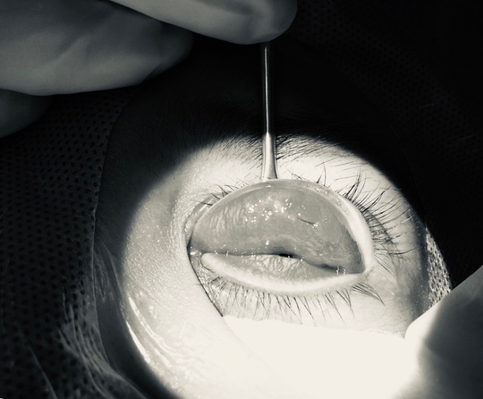 Nhấn mí làm đẹp ở spa, cô gái 25 tuổi bị loét giác mạc nhan mi lam dep o spa co gai 25 tuoi bi loet giac mac