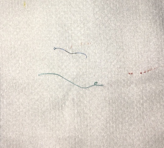 Nhấn mí làm đẹp ở spa, cô gái 25 tuổi bị loét giác mạc nhan mi lam dep o spa co gai 25 tuoi bi loet giac mac