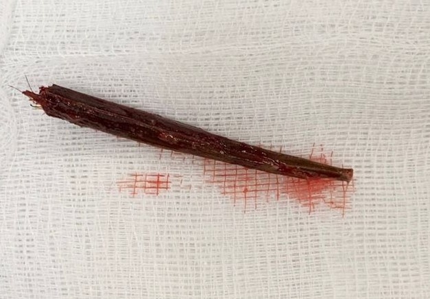 Chàng trai nhập viện vì que xiên thịt đâm thủng tủy sống chang trai nhap vien vi que xien thit dam thung tuy song