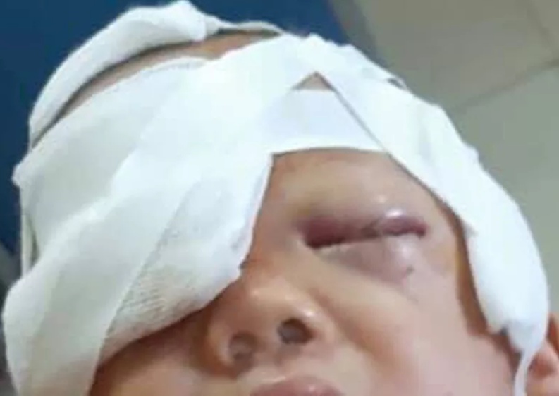 choi trong bep be 20 thang tuoi bi cho nha can nat vung dau mat