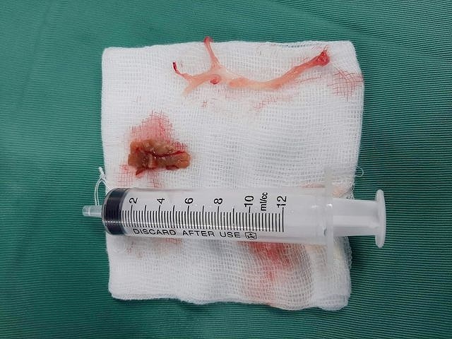 co gai 24 tuoi suyt chet vi hoc thit bo kho