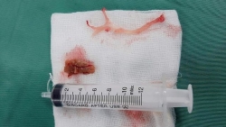 co gai 24 tuoi suyt chet vi hoc thit bo kho