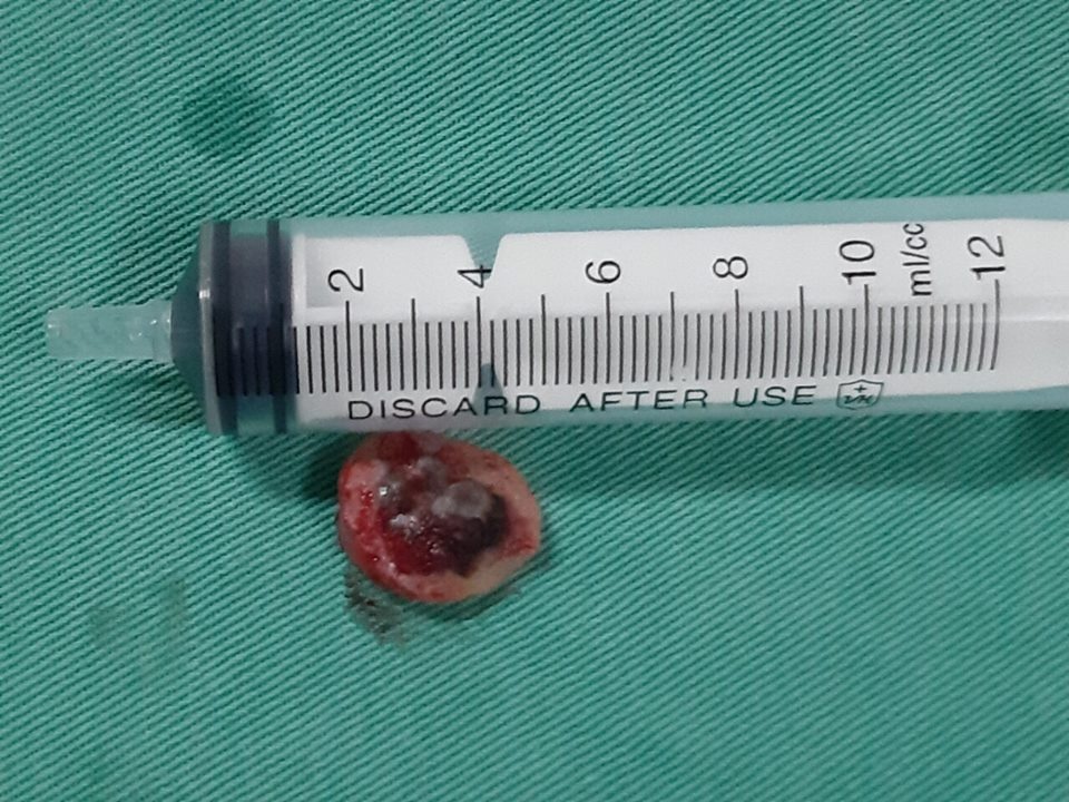 tay not ruoi o spa nu benh nhan bi ung thu da