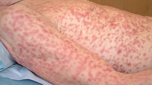 bi lam dung tinh duc nhieu lan be trai 13 tuoi mac benh giang mai