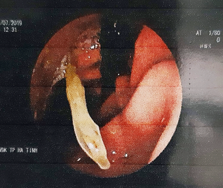 hy huu tam chui tot vao da day vi thoi quen ngam tam truoc khi ngu