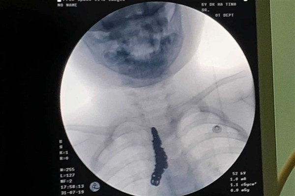 nuot day chuyen bac dai 14cm be trai 2 tuoi cap cuu khan cap