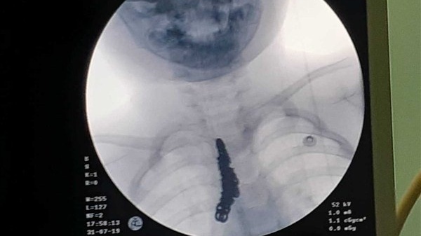 Nuốt dây chuyền bạc dài 14cm, bé trai 2 tuổi cấp cứu khẩn cấp