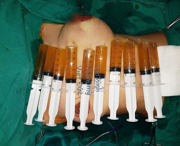 nguc sung to nhu trai bom sap no sau nang nguc lam dep