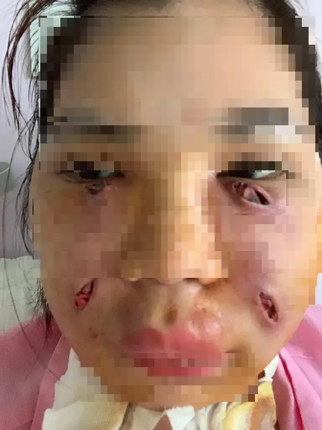 tiem mo lam dep co gai ha noi phai rach mat de nan mu