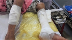 Cụ ông 93 tuổi bị chó nhà cắn nát cẳng chân