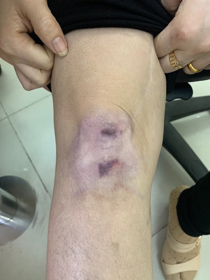dau goi bien chung nang sau chua seo loi o spa