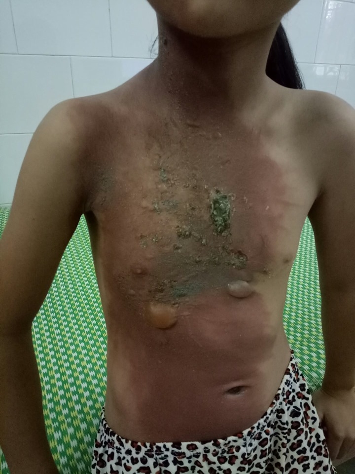 hoai tu chan vi chua bong bang dap thuoc nam
