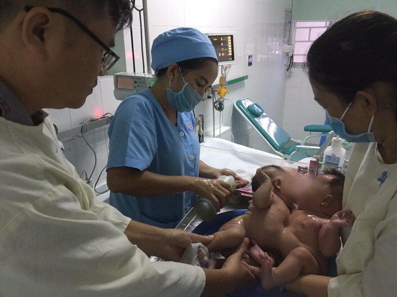 can canh ca phau thuat tach roi cap sinh doi dinh lien bung hon 1 thang tuoi